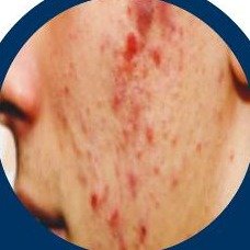 Acne (Khil) skin condition
