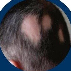 Alopecia areata patchy hair loss