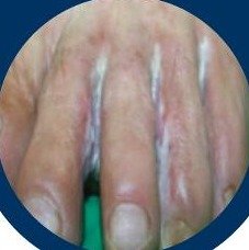 Chilblains