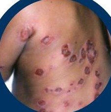 Heat rash in children