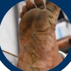 Cracked heels