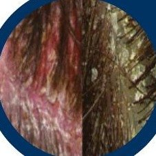 Dandruff and hair fall