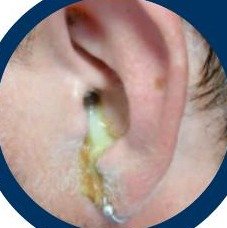 Ear discharge