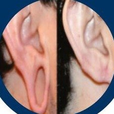 Ear lobe repair