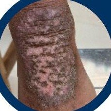 Eczema (Kharajvu) skin condition