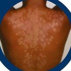 Fungal skin patches