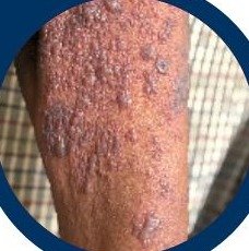 Herpes skin condition