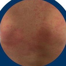 Hives / urticaria