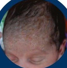 Newborn heat rash
