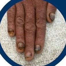 Nail disorders