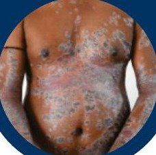 Psoriasis skin condition