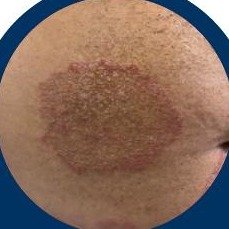 Ringworm (Dadar) skin condition