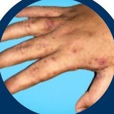 Scabies skin condition