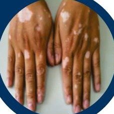 Vitiligo white patches
