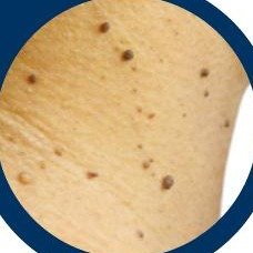Warts