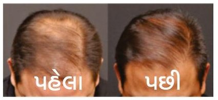 Before and after hair fall treatment result at Shree General Skin & Hair Clinic