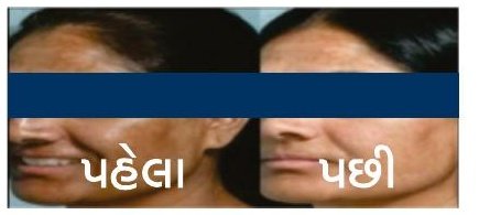 Before and after skin treatment result at Shree General Skin & Hair Clinic
